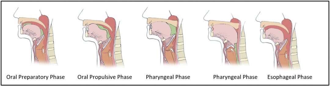 5. Dysphagia, Aspiration, And Nutritional Interventions For Patients 